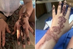 black henna tattoo burns, how long does black henna last, henna tattoo cause aussie woman to almost lose her hand, Tattoos